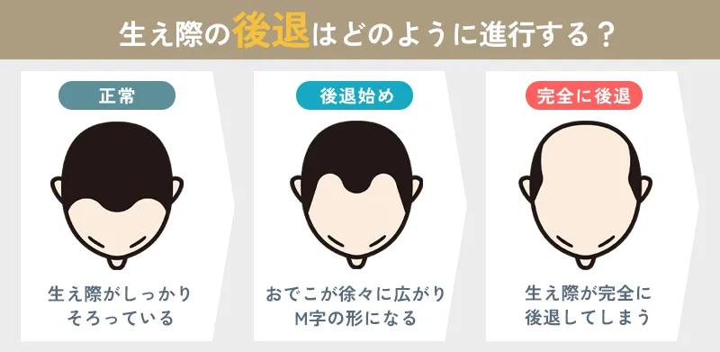生え際の後退の進行の仕方とは？