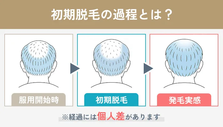 AGA治療初期脱毛の経過