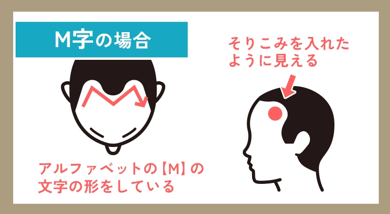 M字型の生え際の形や特徴