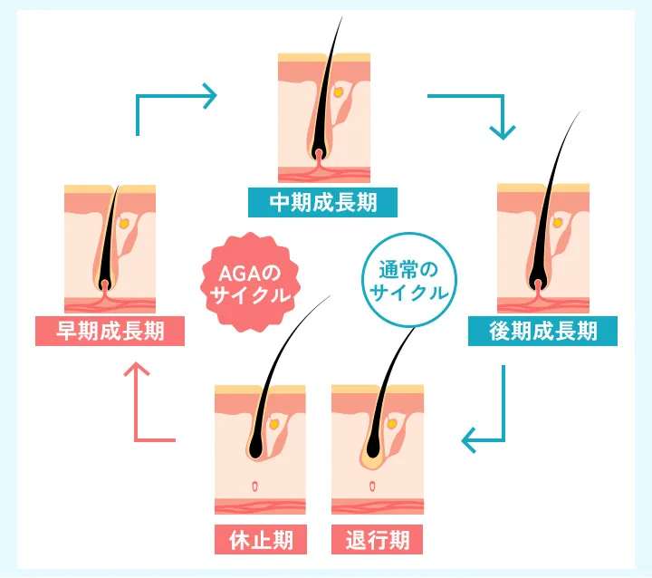 正常なヘアサイクルとAGAのヘアサイクル
