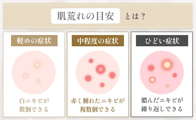 生理前の肌荒れの症状目安